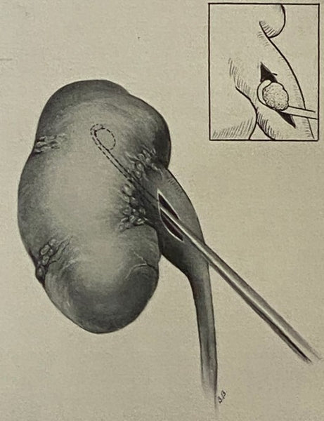 Renal Lithiasis [Kidney Stones]